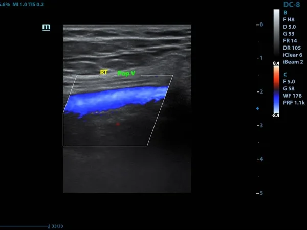 Color Doppler 5