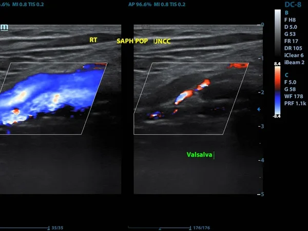 Color Doppler 6