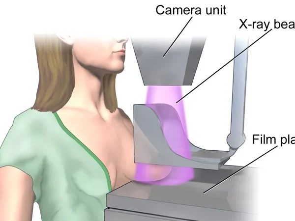 Mammography 2