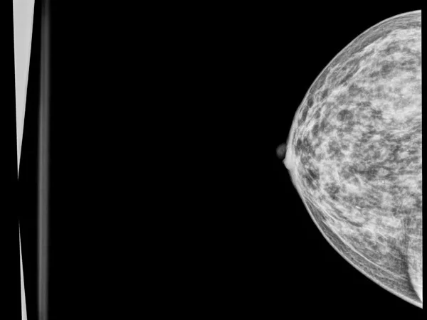 Mammography 3
