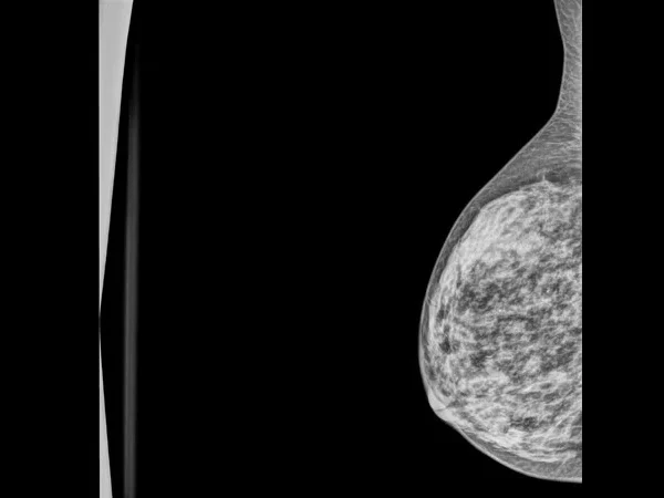Mammography 4