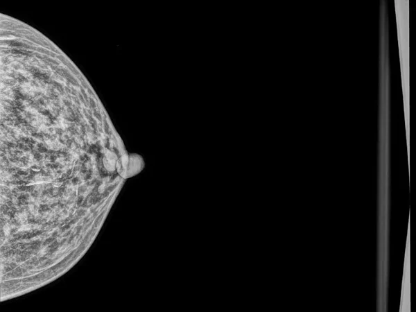 Mammography 5