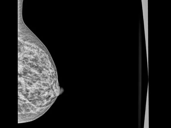 Mammography 6